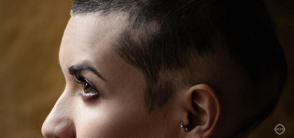 Hair loss patches identifying alopecia areata condition on scalp.
