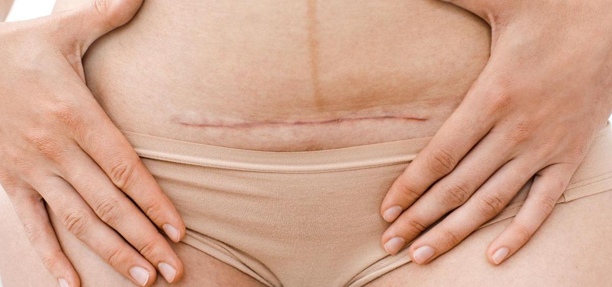 Surgical scar on abdomen from caesarean section, postpartum recovery, medical procedure aftermath.
