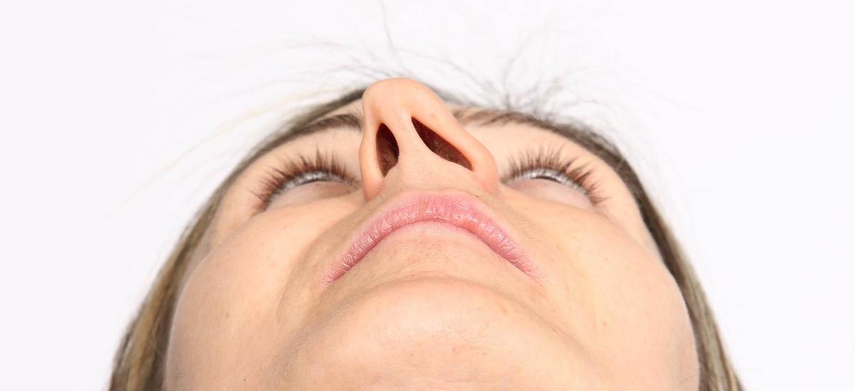 Nasal septum showing deviation in anatomy, causing crooked appearance.
