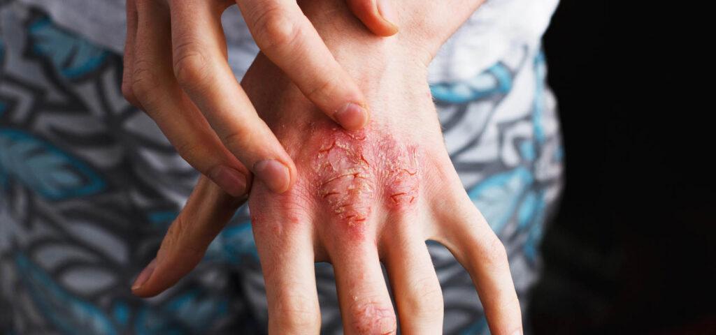 Close-up of irritated skin with redness and dryness, showing symptoms of eczema.