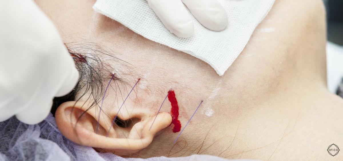 Gender reassignment surgery illustration, showing medical concept and transformation process.