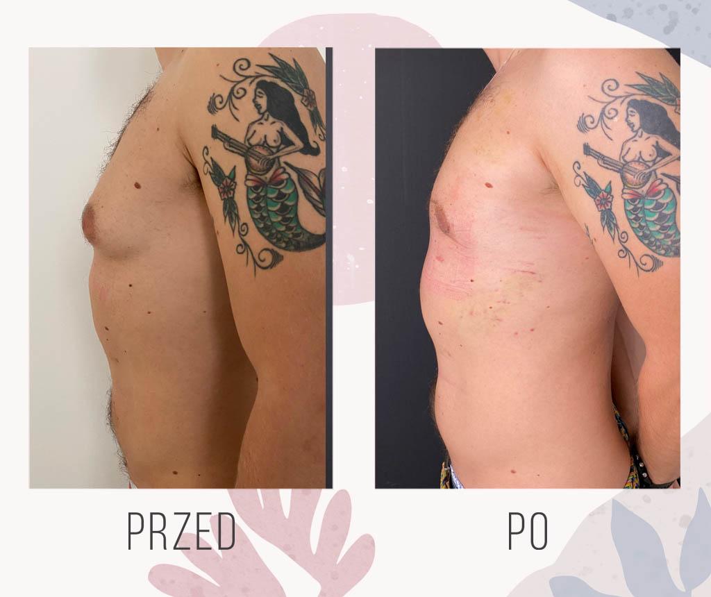 Swollen breast tissue in men, condition known as gynecomastia.