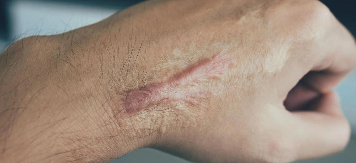 Close-up photo of raised, red hypertrophic scar on skin.