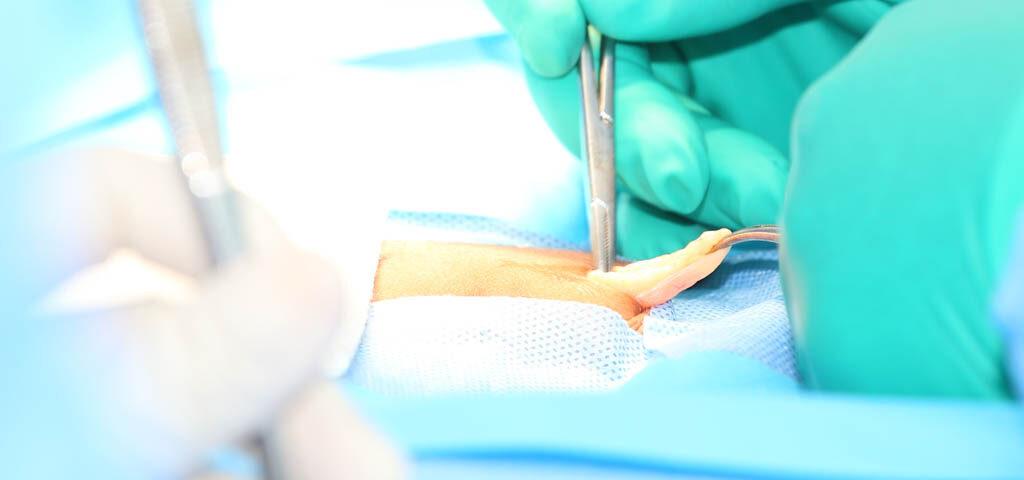 inguinal hernia