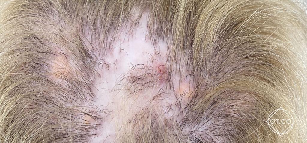 Photo of lichen planus skin rash with purple bumps and streaks.