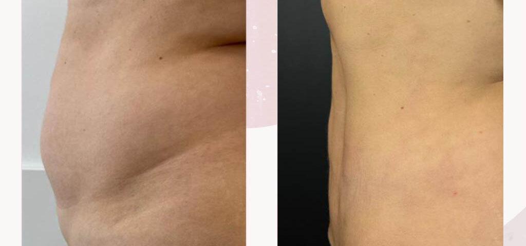 Aesthetic treatment equipment for liposuction and cosmetic procedures in a clinic.