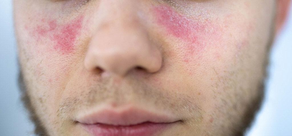 lupus