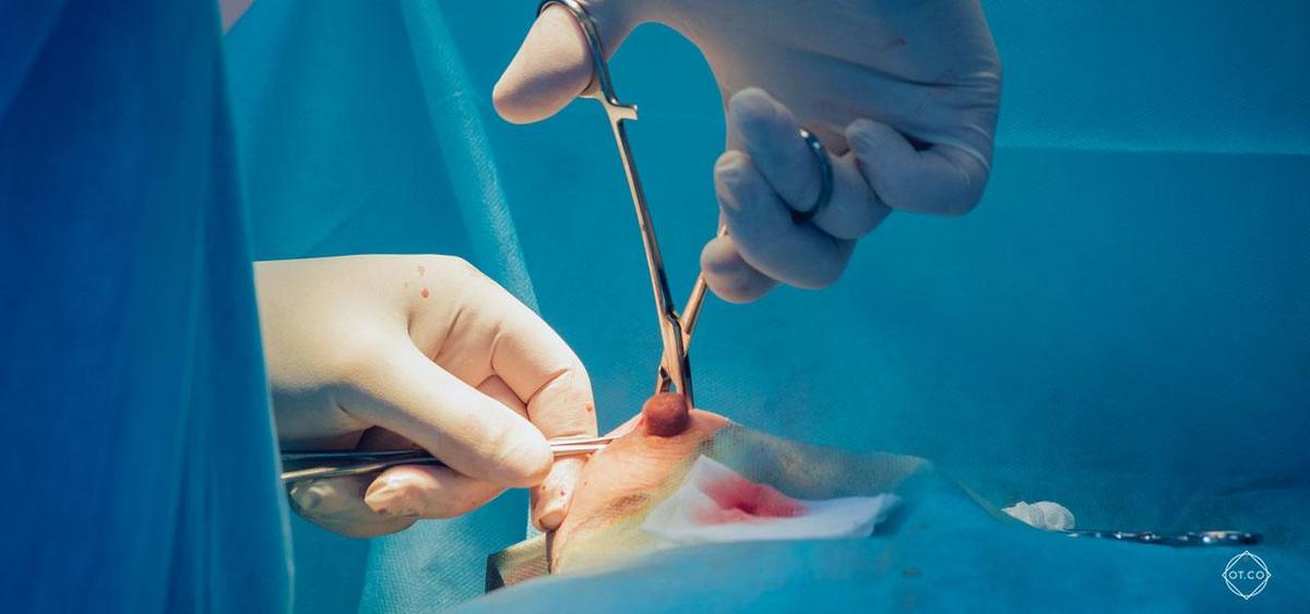 Chirurgie esthétique mammaire montrant une intervention de remodelage ou augmentation mammaire.