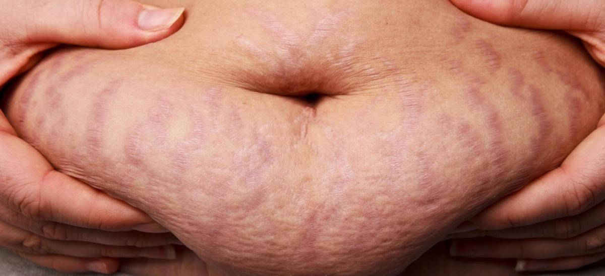 A woman's abdomen after childbirth showing signs of pregnancy.