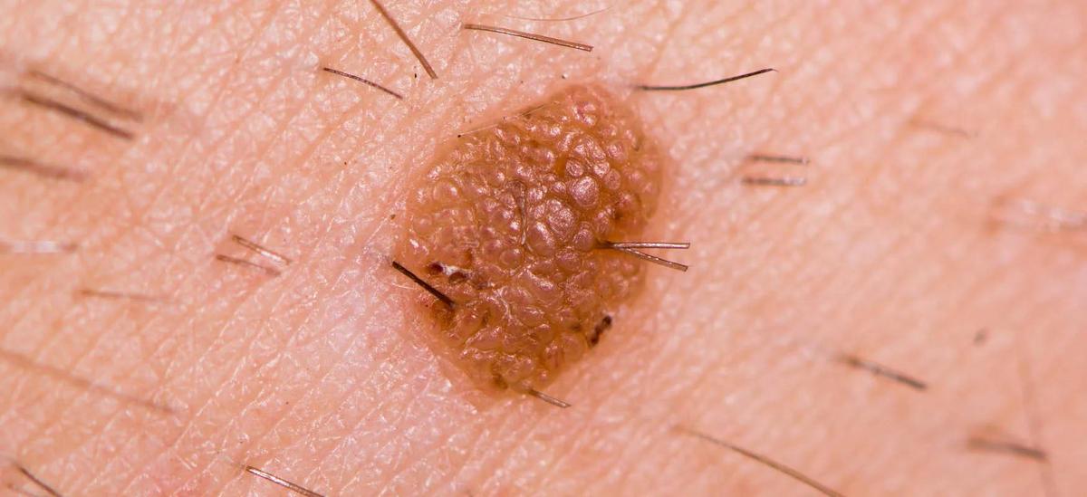 Seborrheic wart on skin, raised and brown in color, with rough surface.