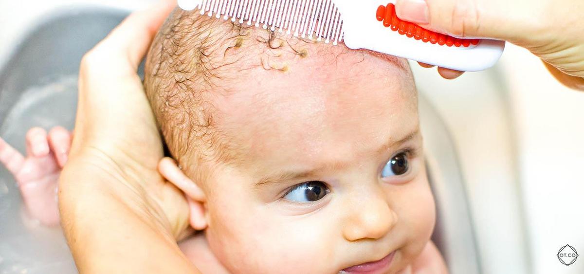 Close-up of scalp with flaky skin, characteristic of seborrhoeic dermatitis.