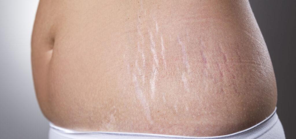 Stretch marks on breasts, natural and beautiful marks of growth and change.