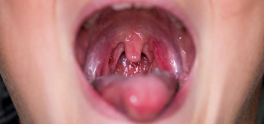 Surgical procedure on a throat, tonsillectomy, medical operation, health care, throat surgery.