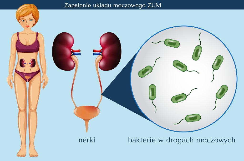 Illustration depicting the human urinary tract system, highlighting areas affected by infection.