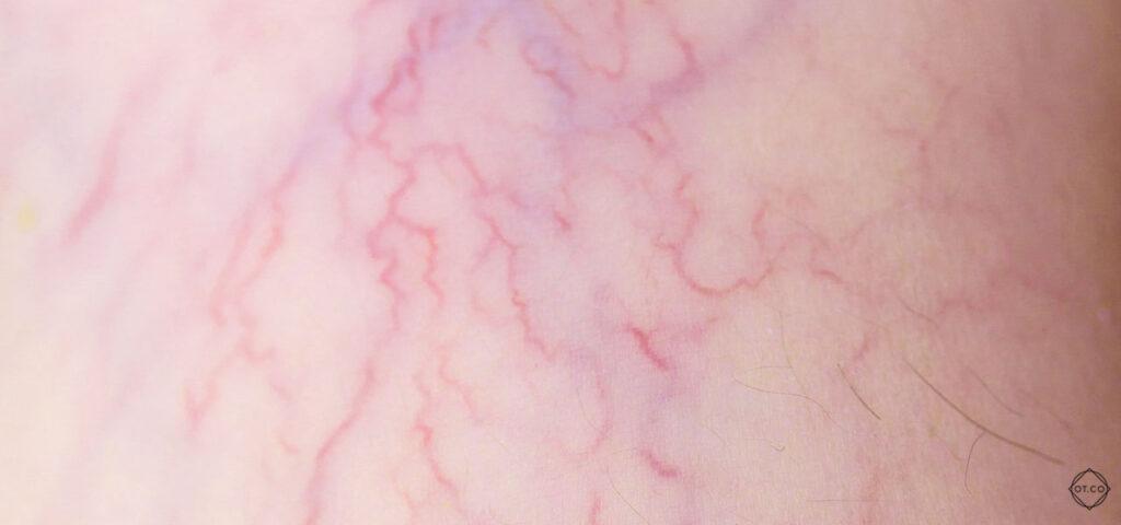 Close-up of varicose veins on a leg, showing twisted and swollen blood vessels.