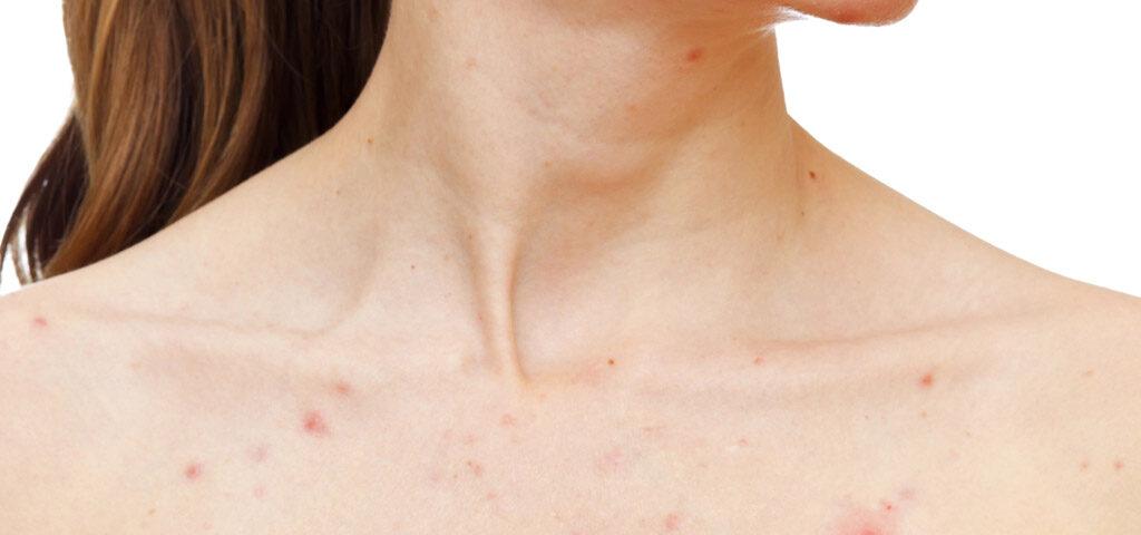 Bild av tillståndet acne inversa med inflammerade områden på huden.