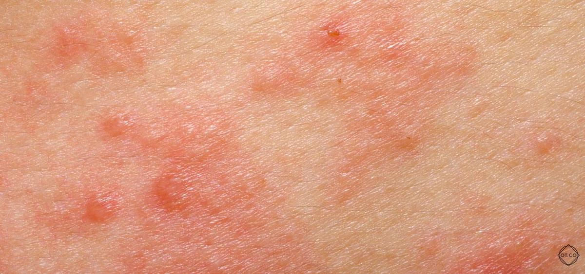 Chronic skin condition with red, itchy, and inflamed patches, characteristic of atopic dermatitis.