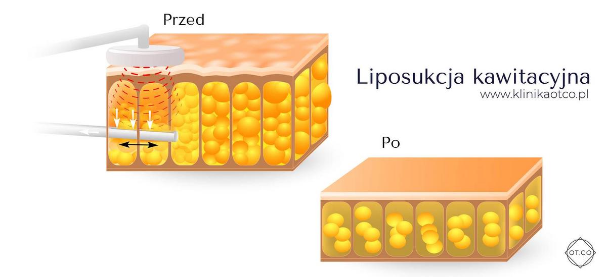 Procedura di liposuzione con cavitazione effettuata per rimuovere il grasso corporeo in eccesso.