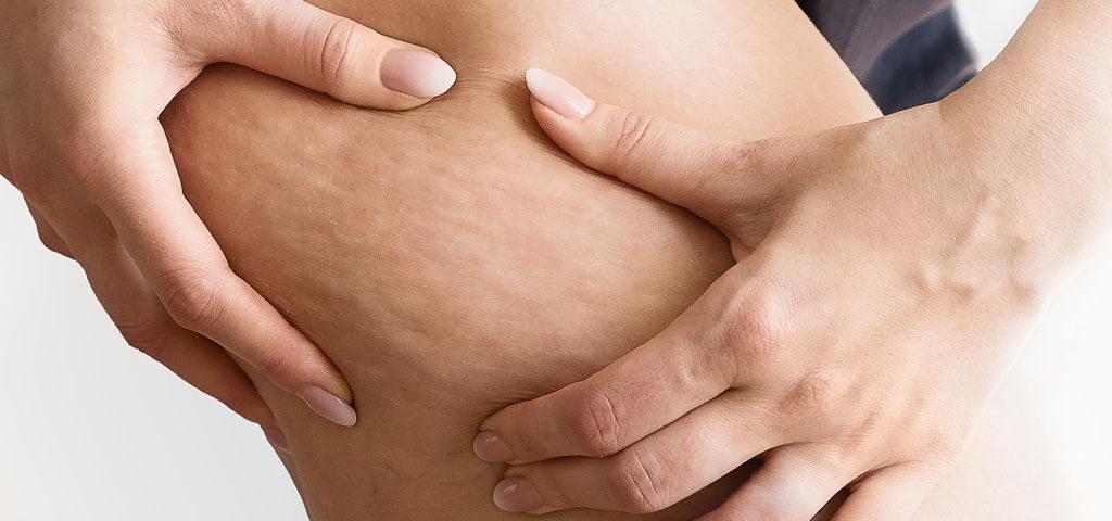 Cellulite visible on the skin of human thighs, showing natural body texture.