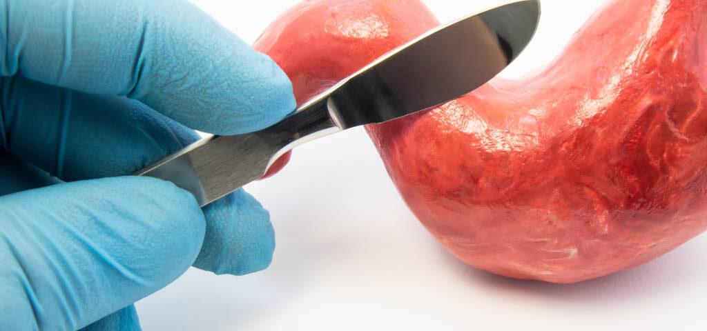 Diet plan and food recommendations for post-bariatric surgery patients.