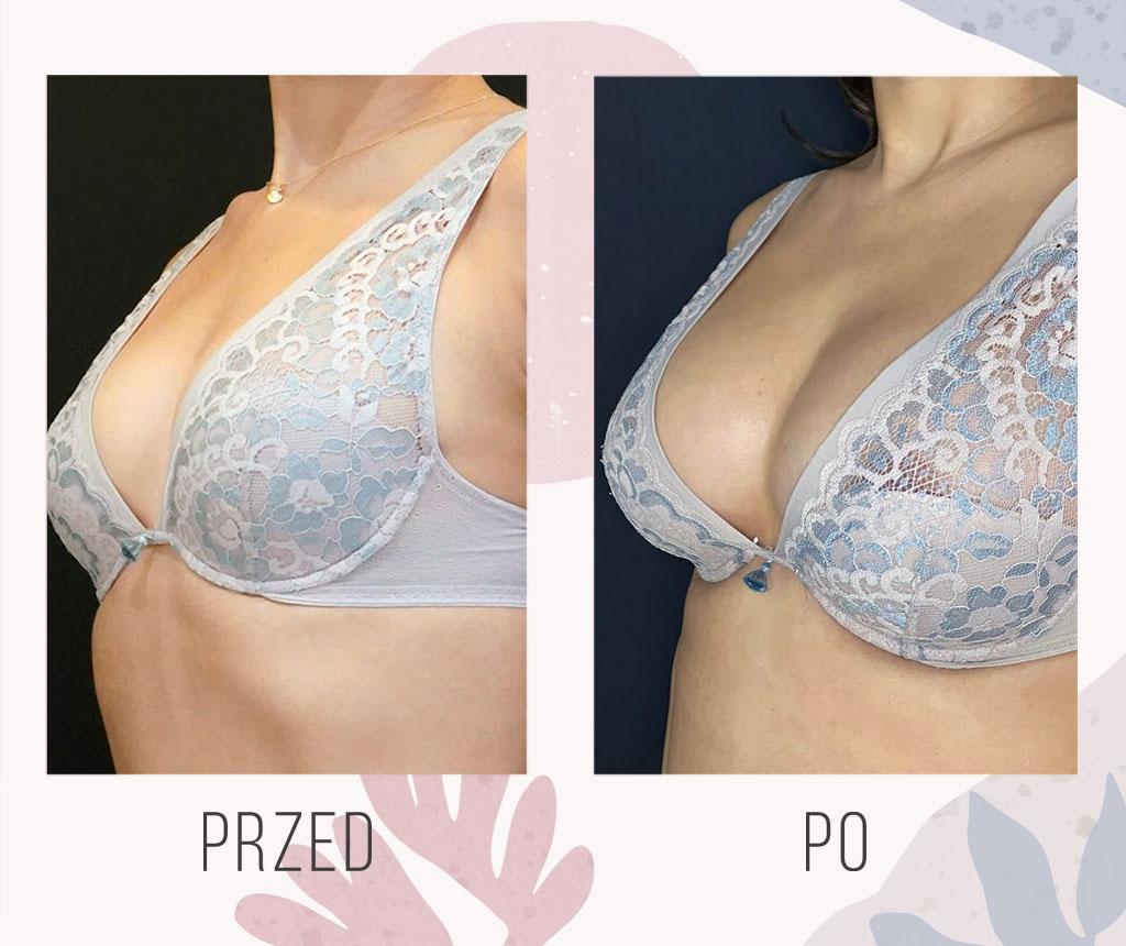 Differentiating features of a natural breast compared to an augmented breast.