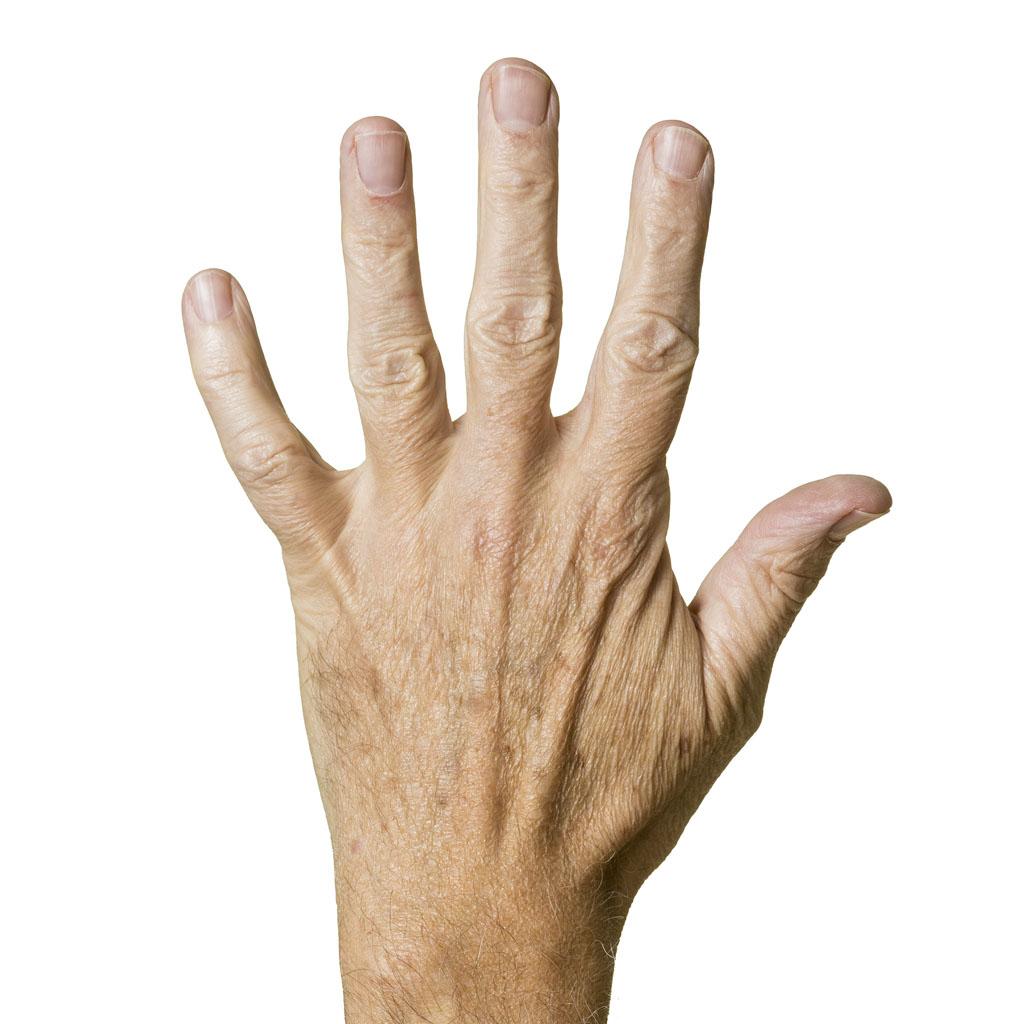 fat grafting for hands