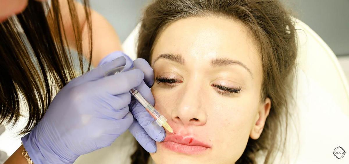 Close-up of lips showing subtle enhancement after a cosmetic lip flip procedure.
