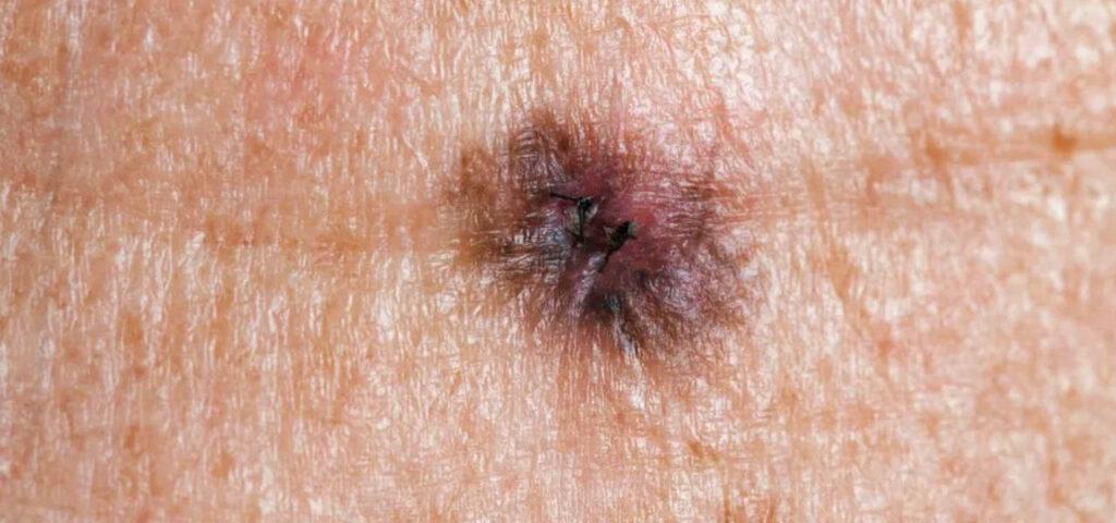 A close-up image showing a melanoma spot on human skin for medical reference.