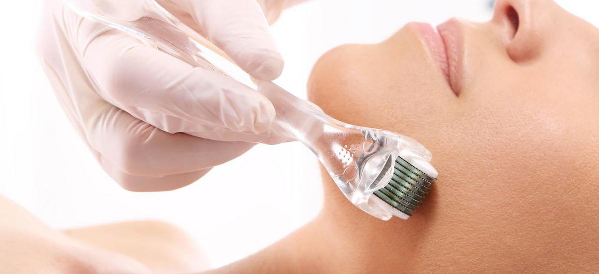 Microneedle mesotherapy procedure with tiny needles targeting skin for rejuvenation and treatment.