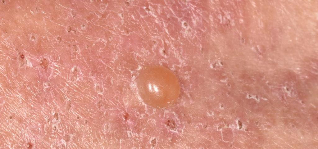 Close-up of skin with red sores and blisters caused by pemphigoid, a rare condition.