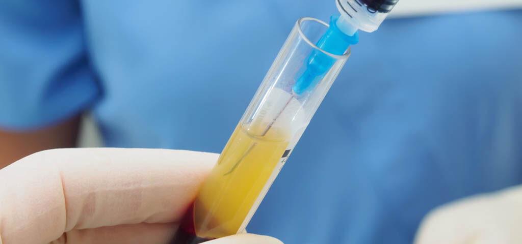 Dichte, gelbe Matrix aus thrombozytenreichem Fibrin auf einer sterilen Oberfläche liegend.