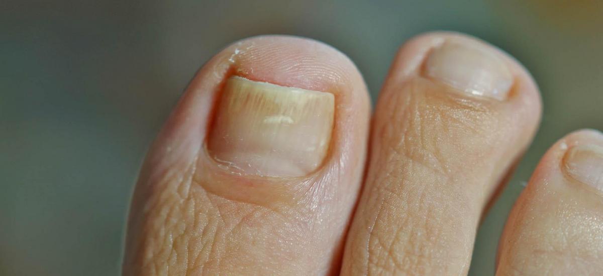 Close-up of skin with red, scaly patches characteristic of psoriasis on the surface.