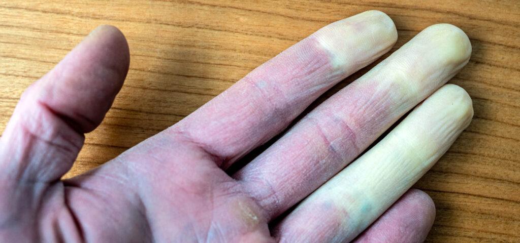 Symptoms of Raynaud's: fingers appearing pale, blue, or red due to restricted blood flow.