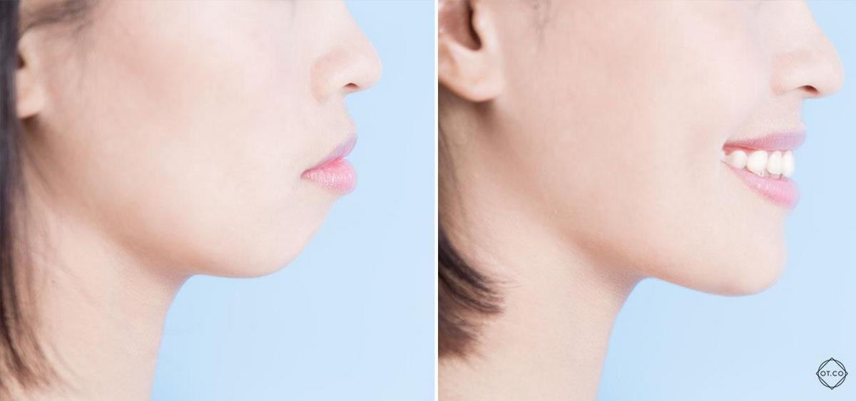 Person with a smoothed jawline, second chin removed for a refined appearance.
