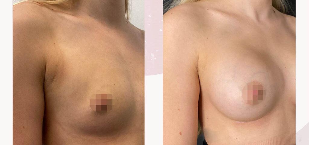 Risks associated with breast augmentation, including potential complications and health concerns.