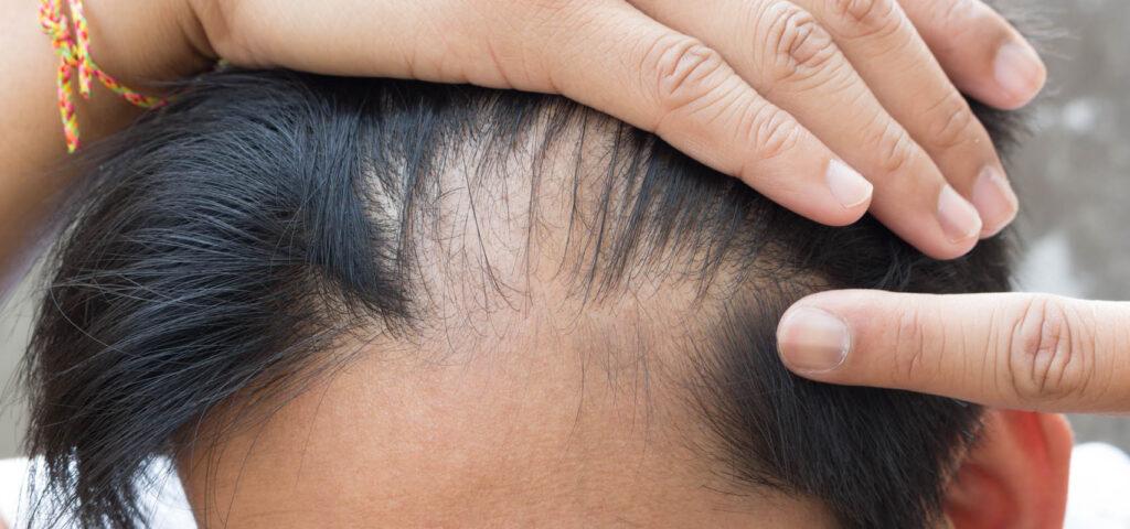 Bild som visar hårbotten med ärrbildning från ärrbildande alopeci och håravfall.