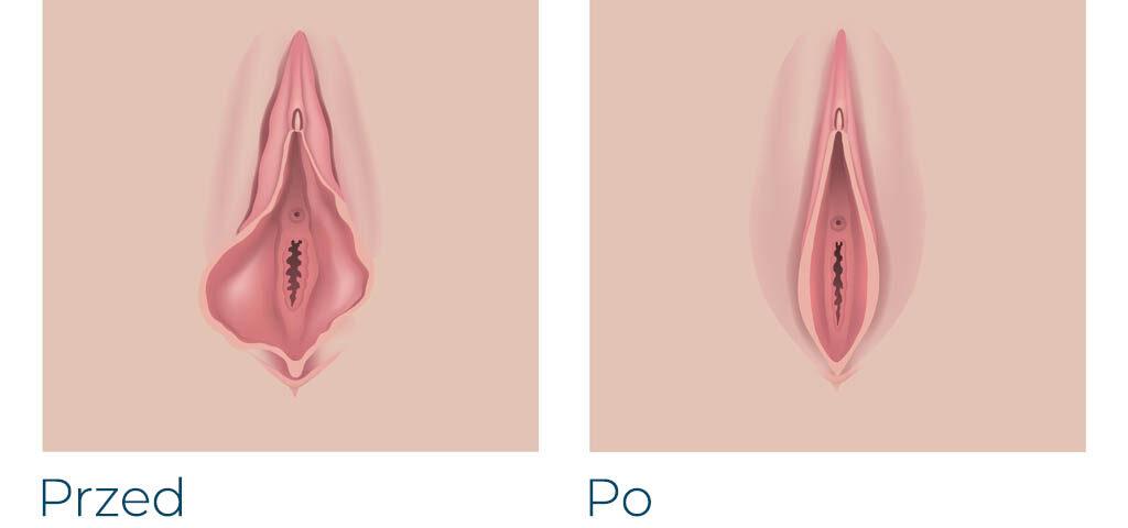 Verschiedene Arten der Labioplastik, schematisch dargestellt mit medizinischen Annotationen.