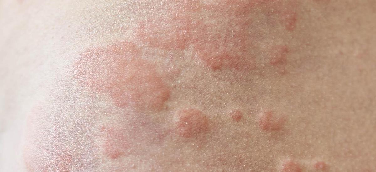 Urticaria