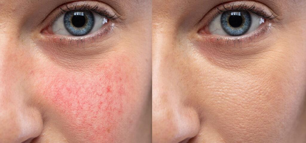 Close-up of vascular skin with visible blood vessels and natural texture.