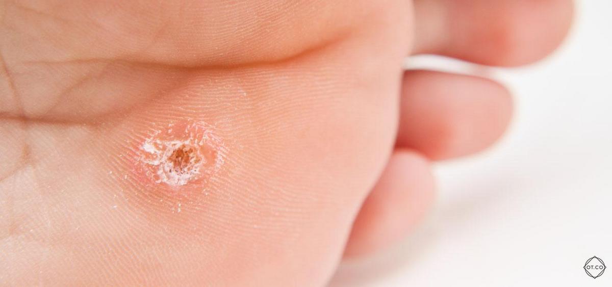 warts on the feet
