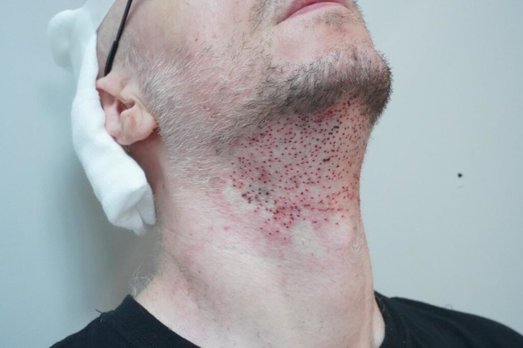 The condition of the skin of the chin immediately after the facial hair transplant