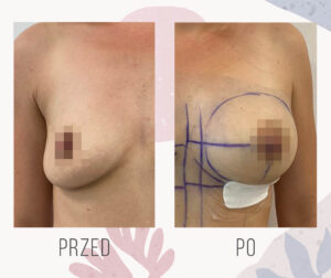 breast increase 10