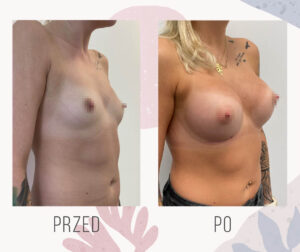 breast lifting with implant