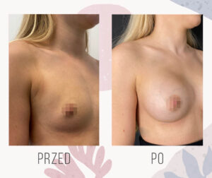 breast photo 1