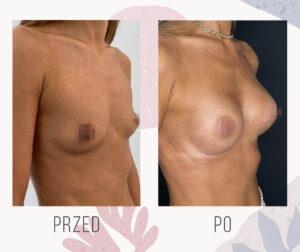 breast photo 3