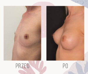 enlarging breast photo 2