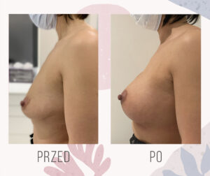 enlarging breasts implants poland