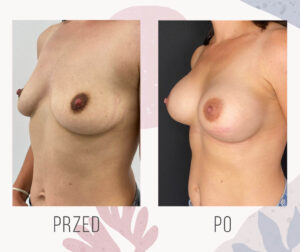 lifting enlargement breast implants