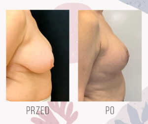 breast lift mastopexy 2