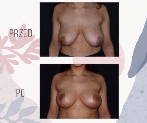 breast lift mastopexy 8
